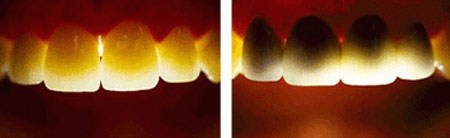 ưu điểm của răng sứ Cercon